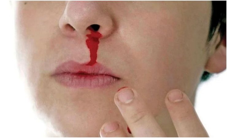 Jangan Baring Jika Hidung Berdarah! Lakukan 6 Langkah Penting Ini